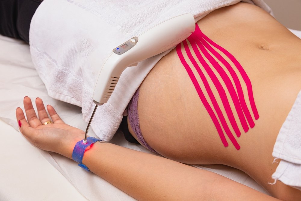 laser acupuncture treatment in Melbourne